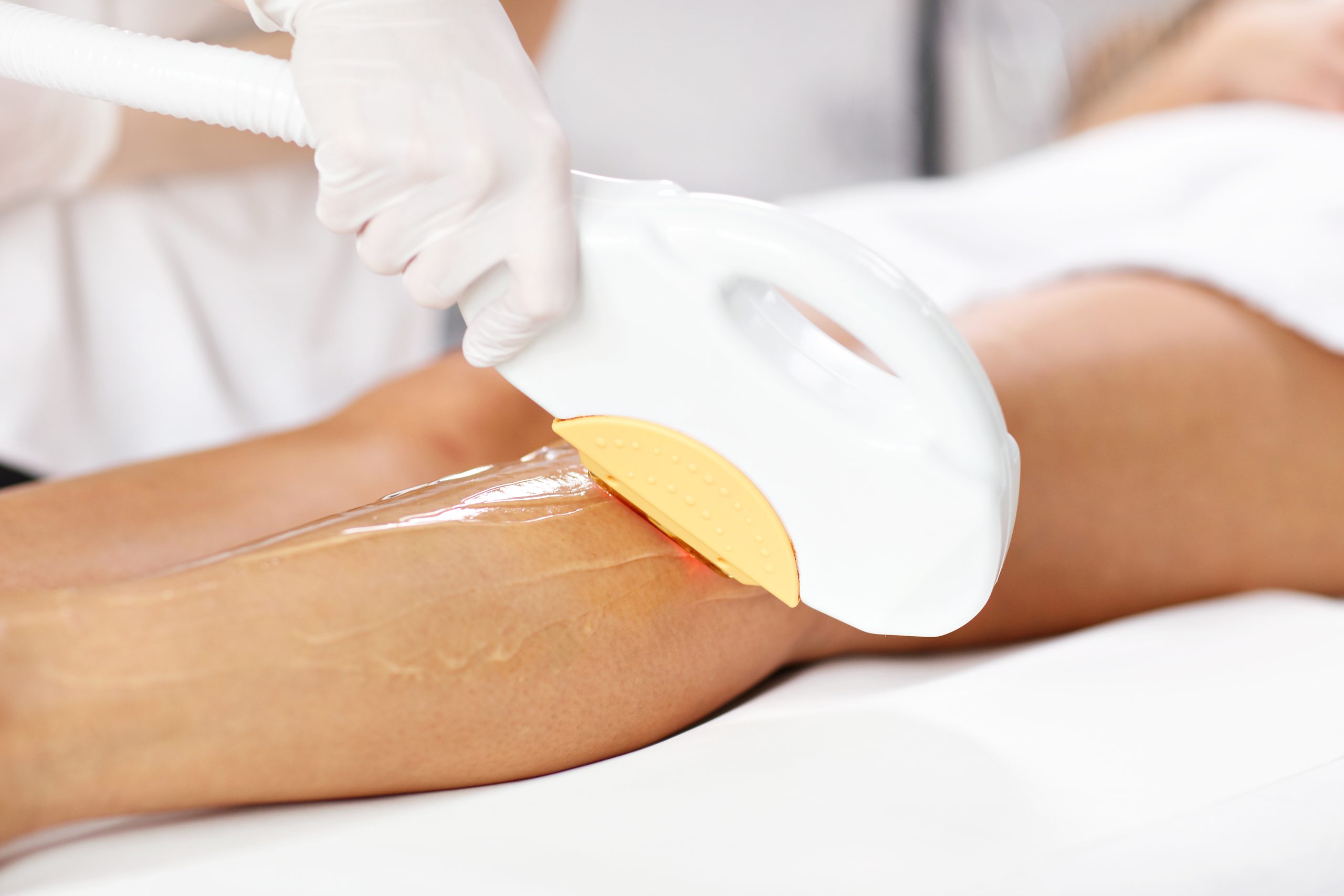 V-IPL  Laser Hair Removal