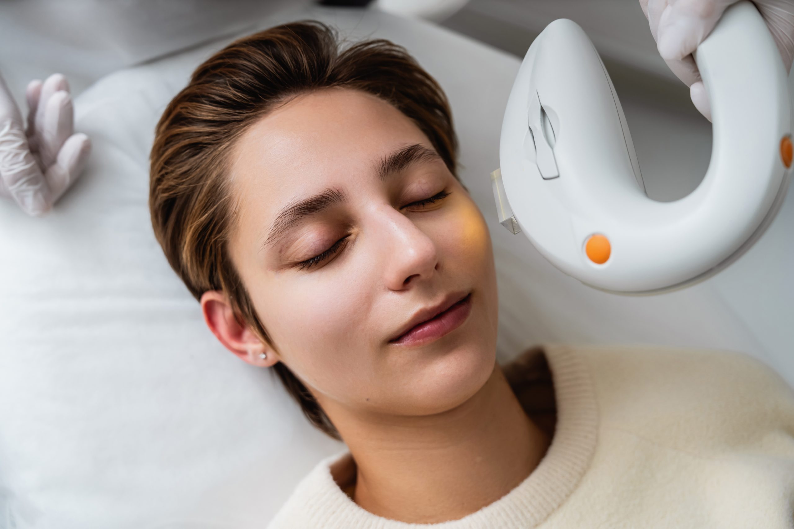 V-IPL Photofacial
